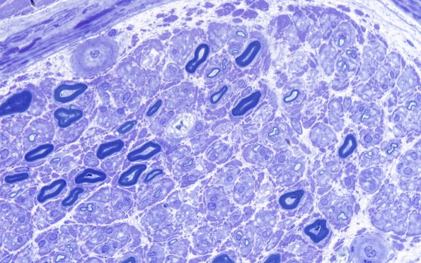 4A2 Vasculopathy (Case 4) Plastic 100X 1