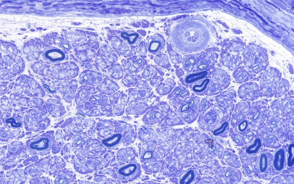 4A3 Vasculopathy (Case 4) Plastic 100X 4