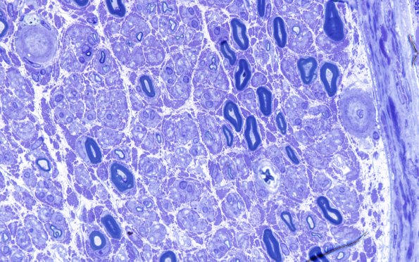 4A4 Vasculopathy (Case 4) Plastic 100X 2