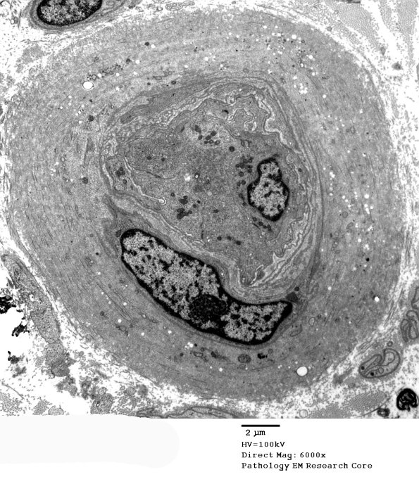 4B1 Vasculopathy (Case 4) EM 013 - Copy