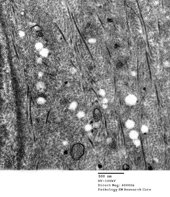 4B3 Vasculopathy (Case 4) EM 15 - Copy