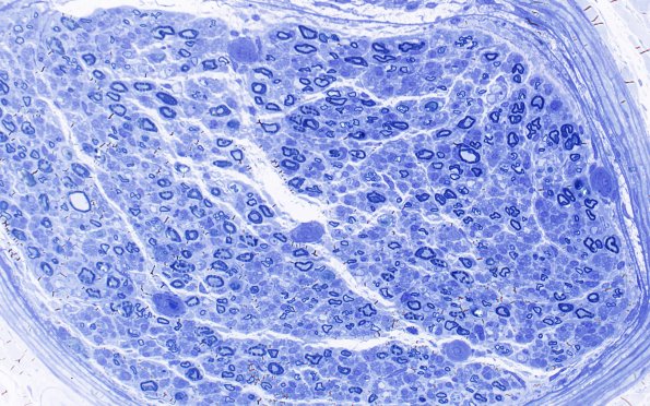 5B1 (Case 5) Plastic 40X 1