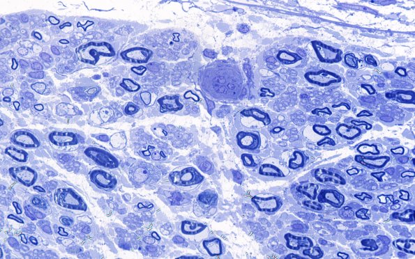 5B2 (Case 5) Plastic 100X 1