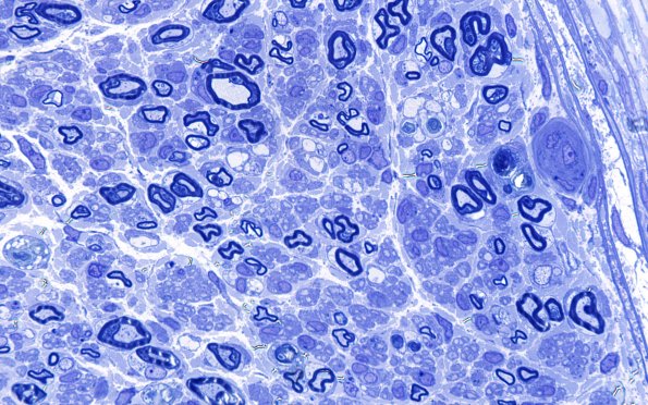 5B3 (Case 5) Plastic 100X 2