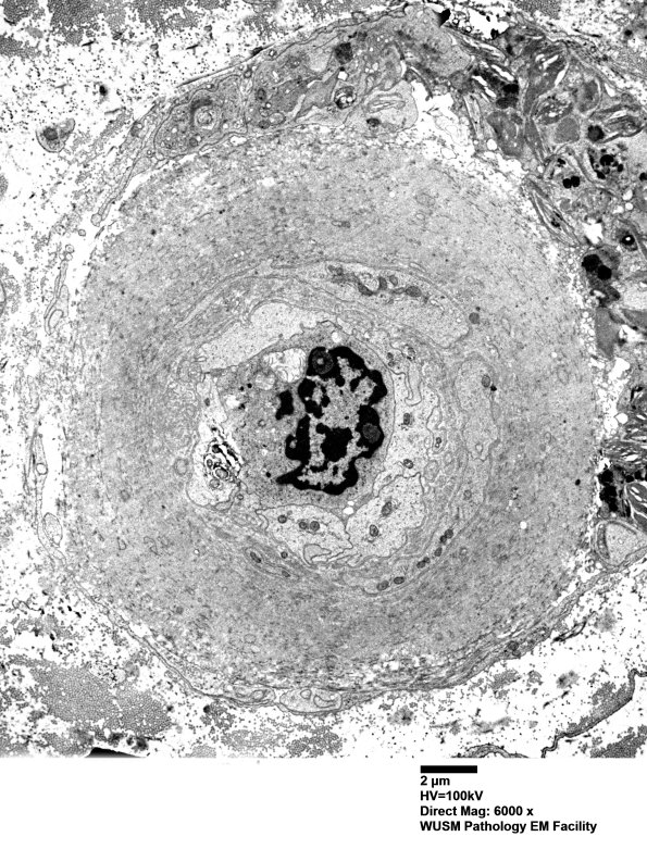 5C1 (Case 5) EM014 - Copy