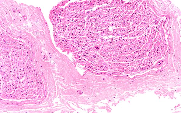 6A1 (Case 6) H&E 20X 1