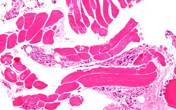 6A3 (Case 6) H&E 10X 1