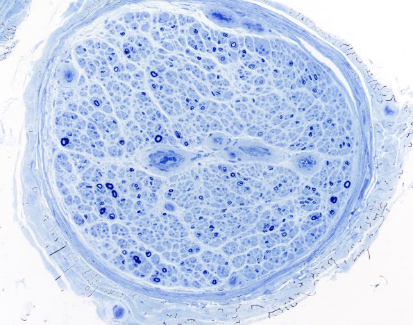 6B1 (Case 6) Plastic 20X 1