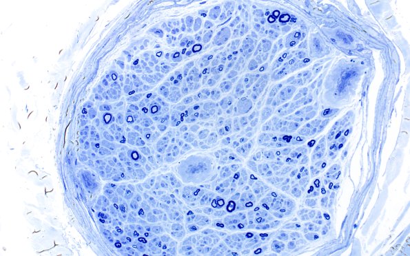 6B4 (Case 6) Plastic 40X 3