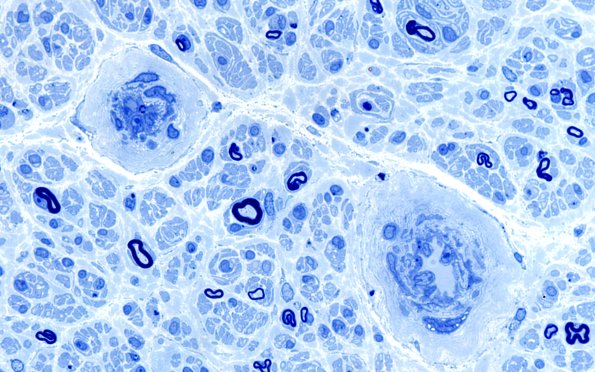 6B5 (Case 6) Plastic 100X 3