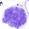9A2-Vascular-Malformation-Case-9-Plastic-4.jpg