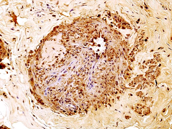 10H Vasculitis (Case 10H) SMA