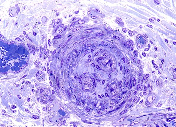 10I Vasculitis (Case 10I) - Copy copy