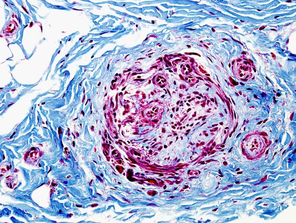 10J Vasculitis (Case 10J) Trichrome 1
