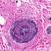 10K1-Vasculitis-Nerve-Case-10K-Elastin-2.jpg