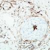 10K3-Vasculitis-Nerve-Case-10K-CD34-1.jpg