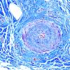 10K4-Vasculitis-Nerve-Case-10K-Trichrome.jpg