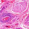 10N1-Vasculitis-Case-10N-H-E-3.jpg