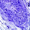10N3-Vasculitis-Case-10N-Plastic-2.jpg