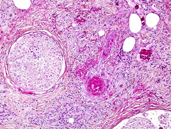11A2 Vasculitis (Case 11) Pentachrome 8