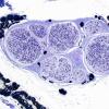 14A2-Vasculitis-Ischemia-Case-14-2.jpg