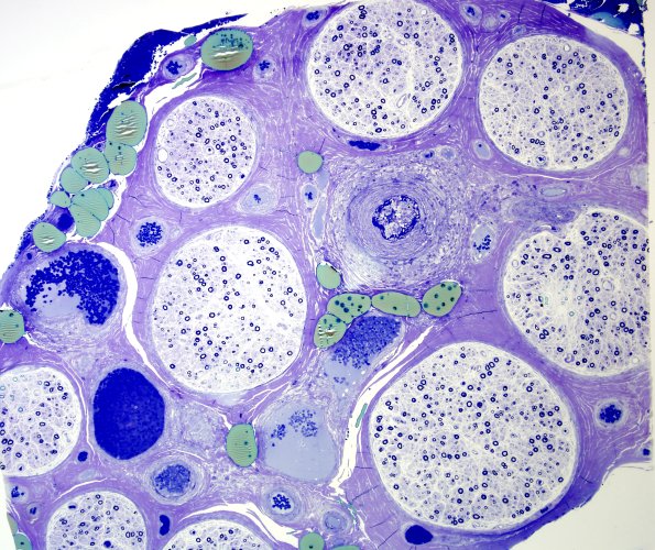 15A1 Vasculitis (Case 15) Plastic 2