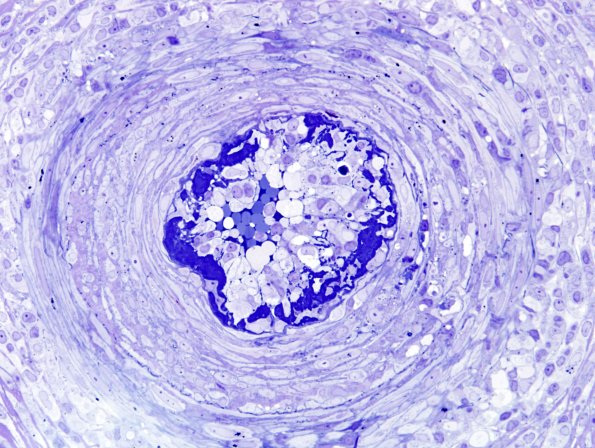 15A2 Vasculitis (Case 15) Plastic 1
