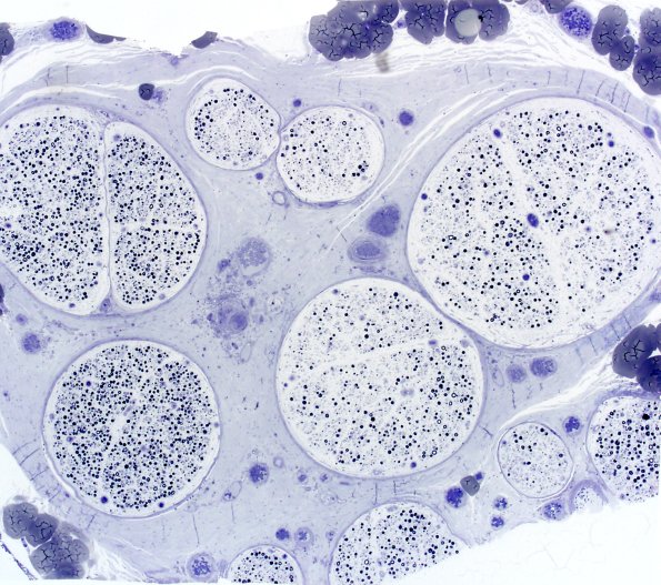 16A1 Vasculitis (Case 16) Plastic 2