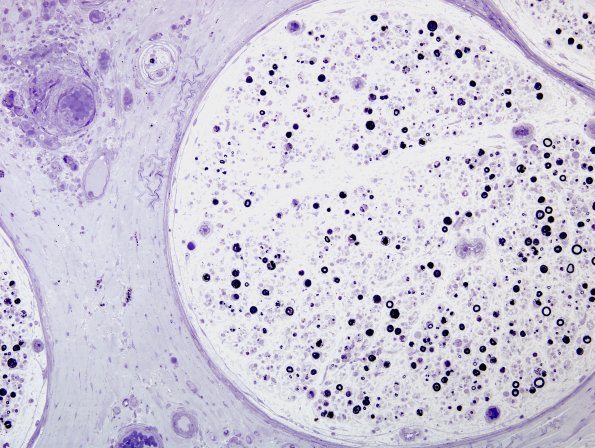 16A2 Vasculitis (Case 16) Plastic 5