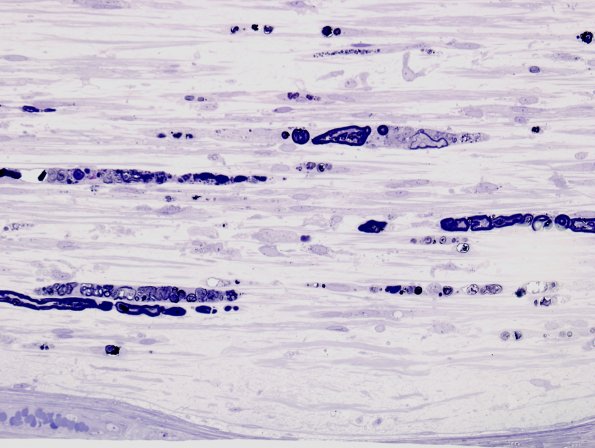 16B1 Vasculitis (Case 16) Plastic 1