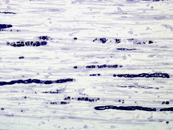 16B2 Vasculitis (Case 16) Plastic 10