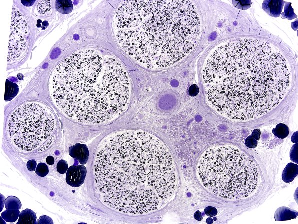 18A1 Vasculitis (Case 18) Plastic 1