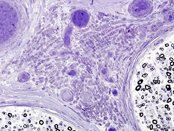 18A2 Vasculitis (Case 18) Plastic 3
