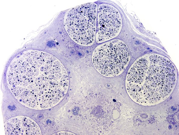 19A1 Vasculitis (Case 19) Plastic 2