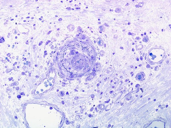 19A2 Vasculitis (Case 19) Plastic 4
