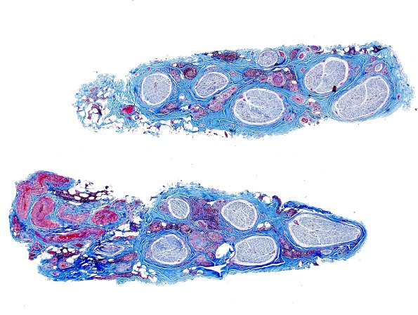 22B1 Vasculitis (Case 22) Trichrome 2