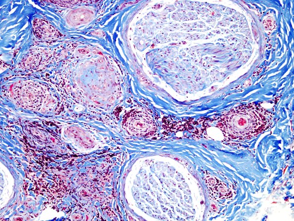 22B2 Vasculitis (Case 22) Trichrome 1