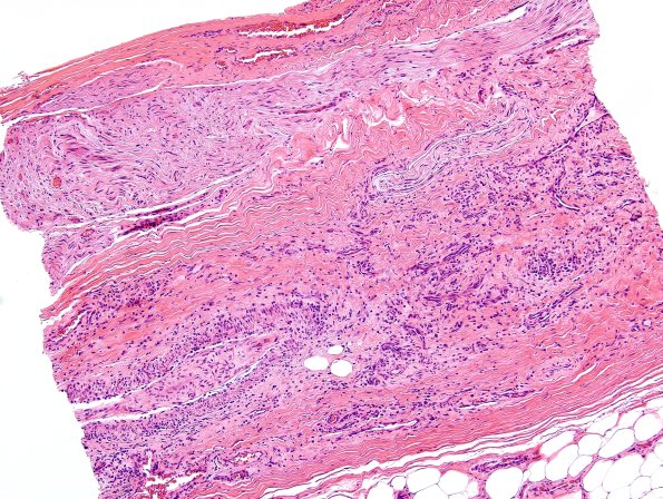 23A1 Vasculitis (Case 23A) H&E