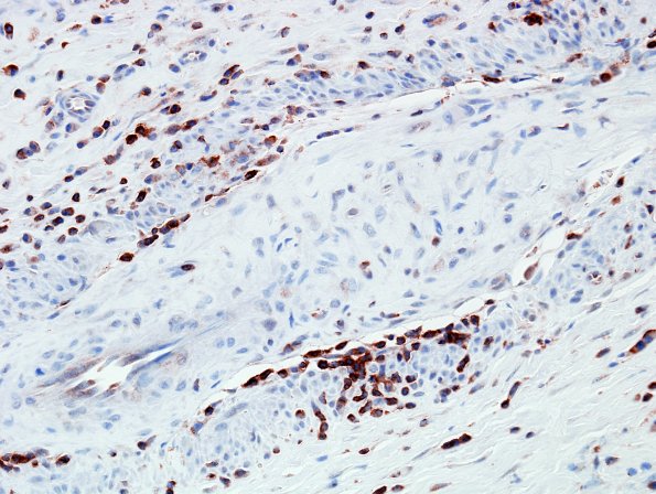 23B1 Vasculitis (Case 23B) CD3 2