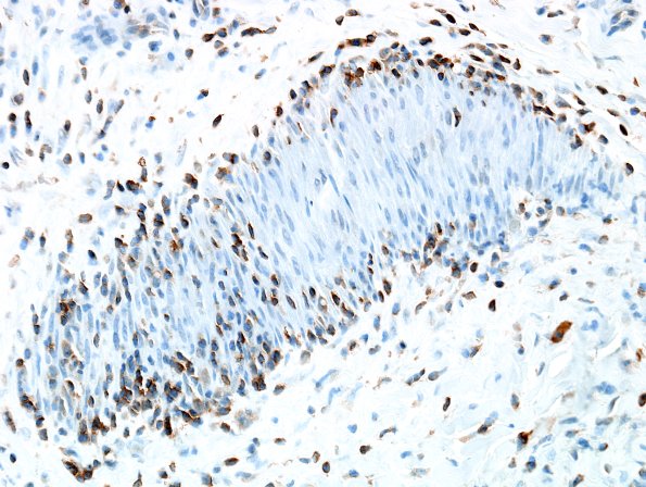 23B2 Vasculitis (Case 23B) CD3