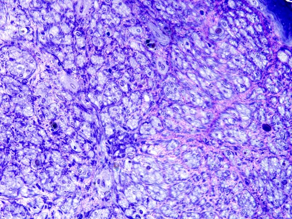 23D1 Vasculitis (Case 23D) Plastic 1