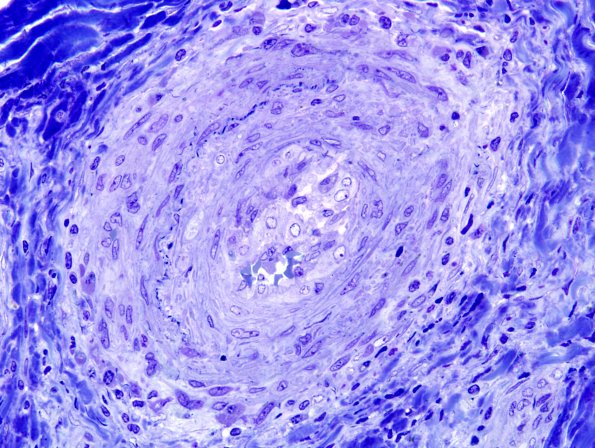 23D2 Vasculitis (Case 23D) Plastic 3