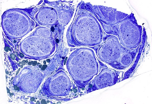 25C1 Vasculitis (Case 25) Plastic 2