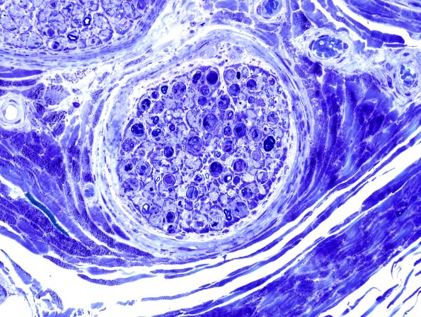 25C2 Vasculitis (Case 25) Plastic 3