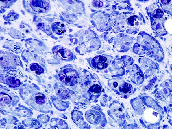 25C3 Vasculitis (Case 25) Plastic 11