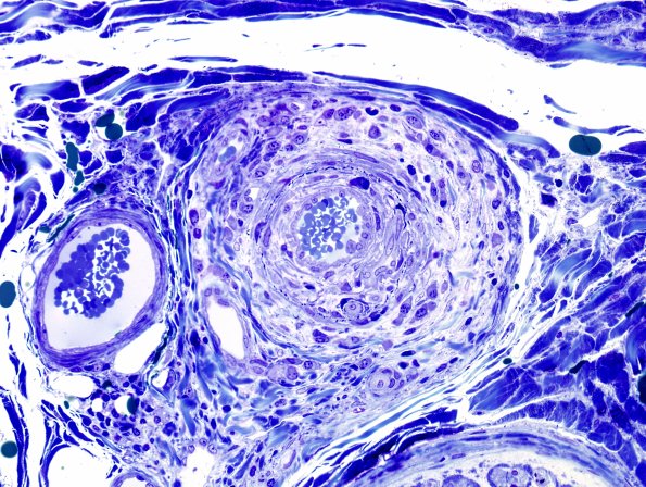 25C4 Vasculitis (Case 25) Plastic 7