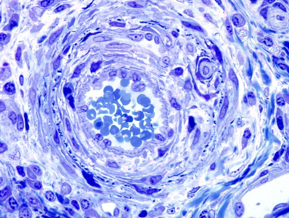 25C5 Vasculitis (Case 25) Plastic 10