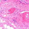 26A2 Vasculitis, nerve (Case 26) H&E 20X