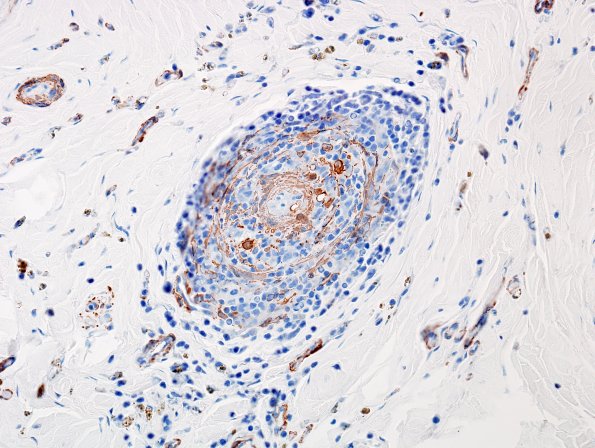 27B1 Vasculitis (Case 27) SMA 1