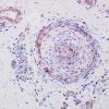 27B2 Vasculitis (Case 27) SMA 2